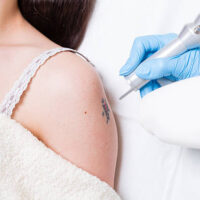 Laser Tattoo Removal
