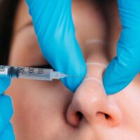 Advanced Dermal Fillers (Tear Trough, Rhinoplasty)